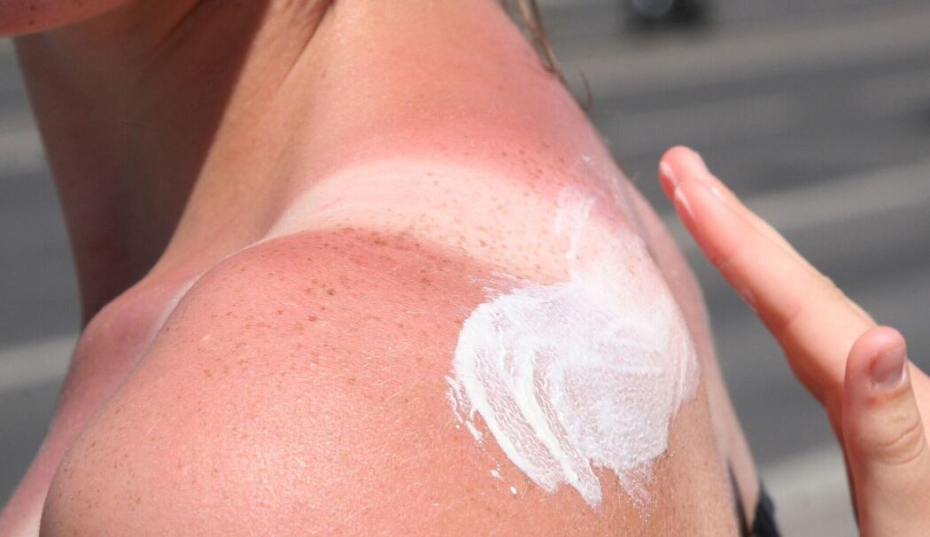 Eine Frau trägt Creme auf einen Sonnenbrand auf