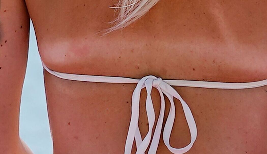 Bräunungsstreifen durch einen Bikini am Rücken einer Frau