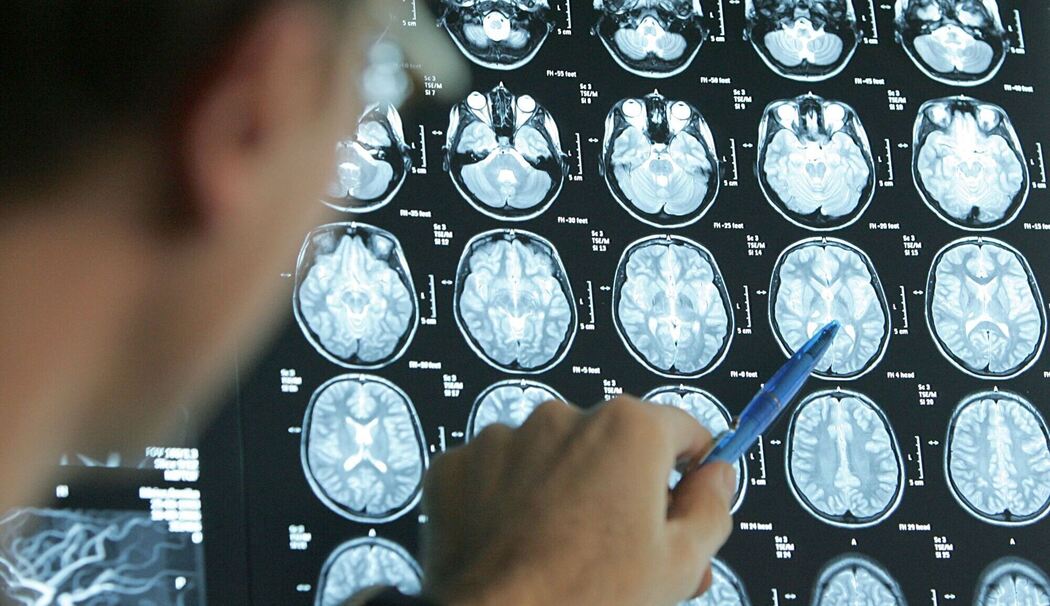 Arzt beurteilt Gehirnquerschnitte einer Schlaganfall-Patientin
