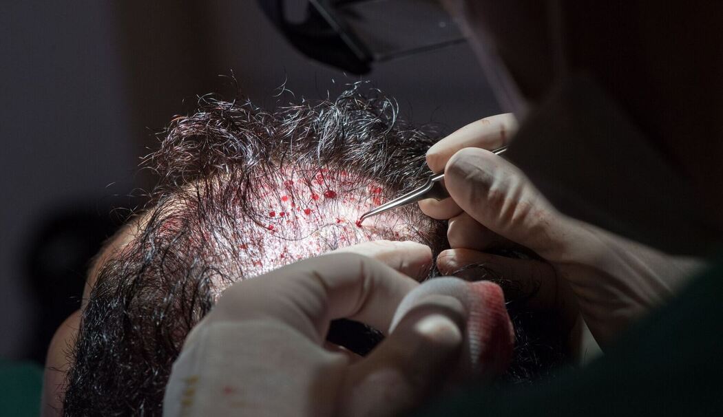Haartransplantation nach der FUT-Methode bei einer Patientin Haartransplantation nach der FUT-Methode bei einer Patientin