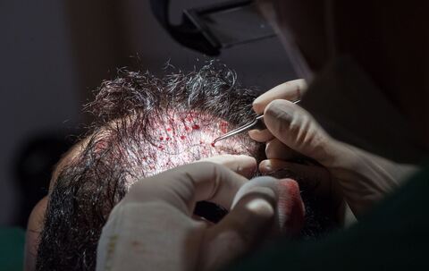 Haartransplantation nach der FUT-Methode bei einer Patientin
