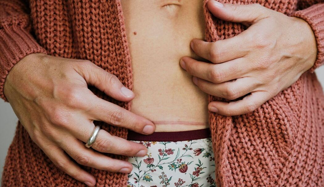 Eine Frau berührt ihre Kaiserschnittnarbe